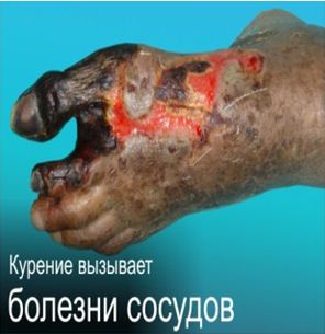 Kazakhstan 2013 Health Effects vascular system - gangrene, necrosis, gross